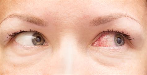 Why Are My Eyes Bloodshot? | Long Island Assisted Living