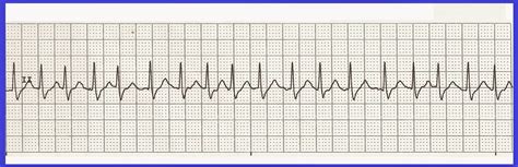 Basic EKG Rhythm Test 14