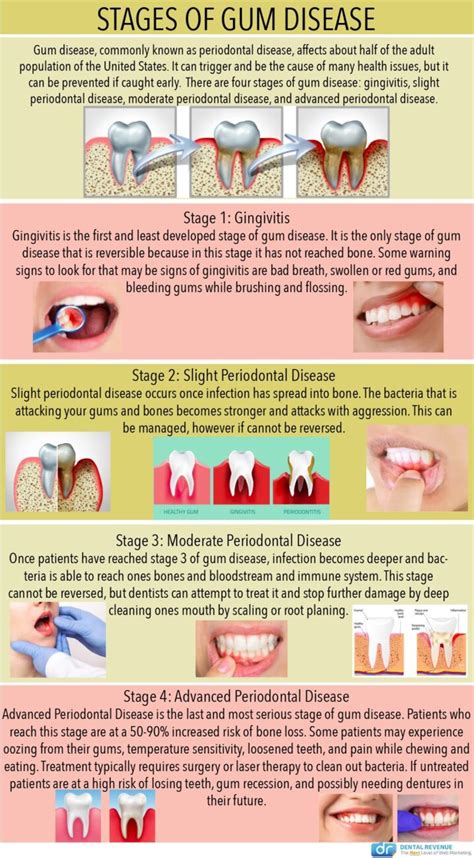 Gum Infection Treatment