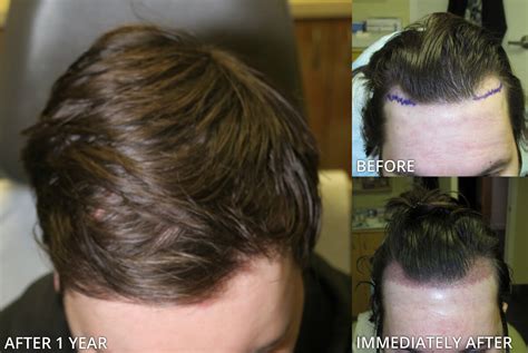 FUE Hair Transplantation – Before and After Pictures * | Dr Turowski - Plastic Surgery Chicago