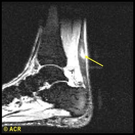 MRI Musculo-Skeletal Section: Partial tear tendon Achilles ( MRI ).