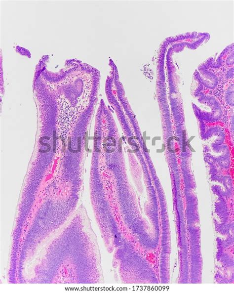 Superficial Portion Villous Adenoma Colonic Polyp Stock Photo ...