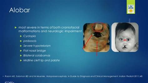 Holoprosencephaly