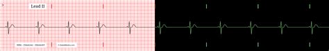 The Sinus Bradycardia EKG/ECG