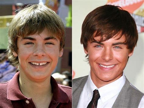 Zac Efron back in the day. Teeth improvement! #celebritydentistry #celebritieswithveneers # ...