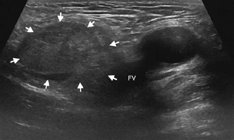 Femoral Canal Hernia