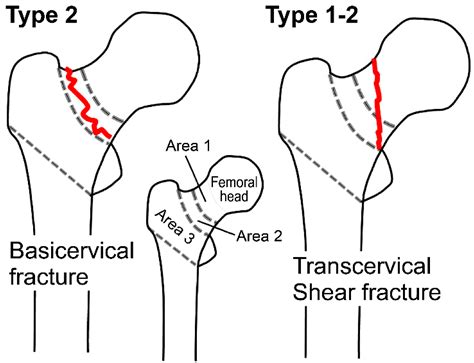 Characteristics and Treatment Strategies for Basicervical and ...