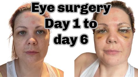 My Blepharoplasty experience eyelid surgery and recovery day 1 to 6 - YouTube