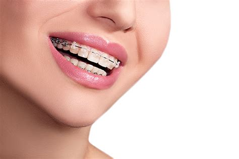 How to Care for Ceramic Braces - Belmont Smiles - Orthodontist Belmont, MA