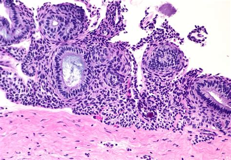 Pathology Outlines - Adenomatoid odontogenic tumor