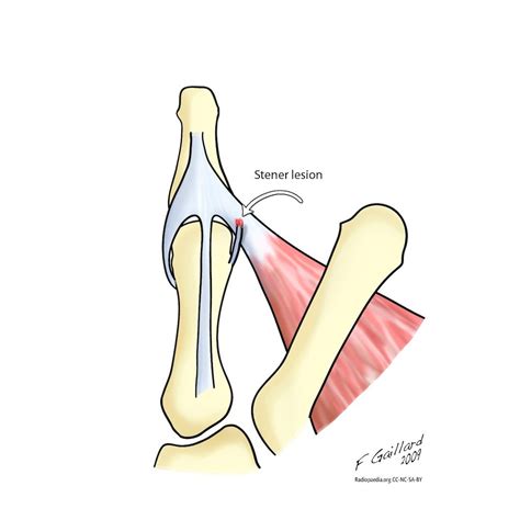 Gamekeeper's thumb and Stener lesion diagrams | Radiology Case | Radiopaedia.org | Radiology ...