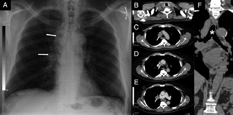 A, Chest radiograph showing normal lung parenchyma and opacity at the ...