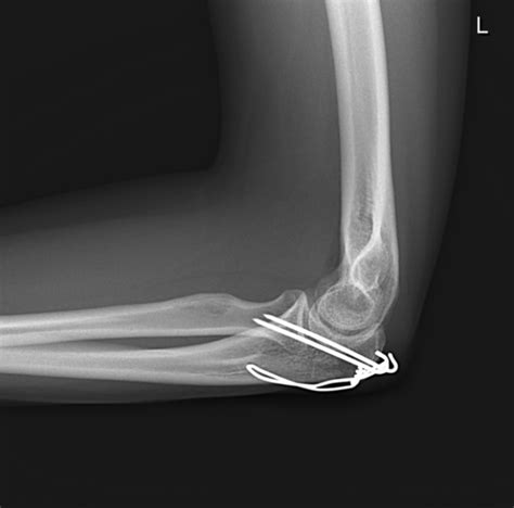 Fractures of the Olecranon and Proximal Ulna - Cancer Therapy Advisor