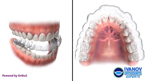 What Are The Different Types of Dental Appliances of Orthodontics?