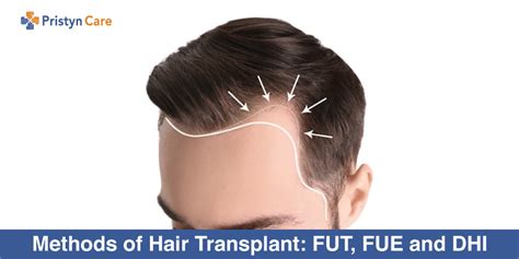 Methods of Hair Transplant: FUT, FUE and DHI