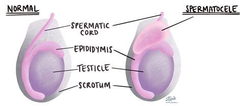 Spermatocele | MyPathologyReport.ca