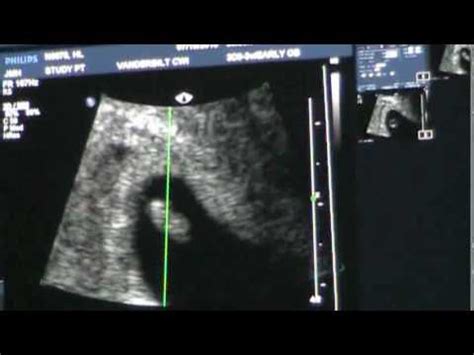 6 Week Ultrasound (Baby's Heartbeat) - YouTube