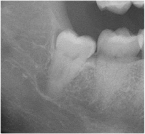 Plain radiograph showing a juxta-apical radiolucency associated with a... | Download Scientific ...