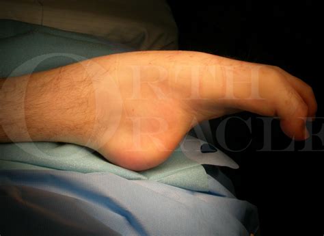 Achilles tendon and posterior ankle release for severe ankle equinus ...