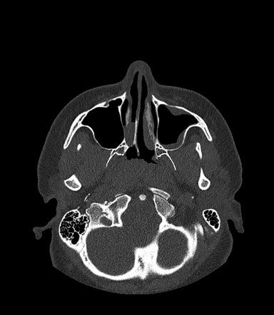 Unilateral choanal atresia | Image | Radiopaedia.org