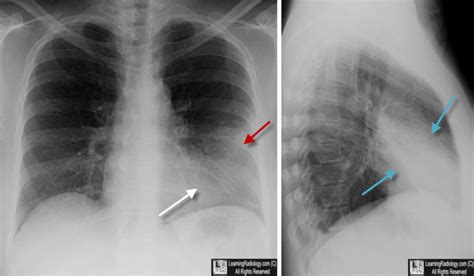 Learning Radiology - Lingula, pneumonia, lingular, left, upper, lobe