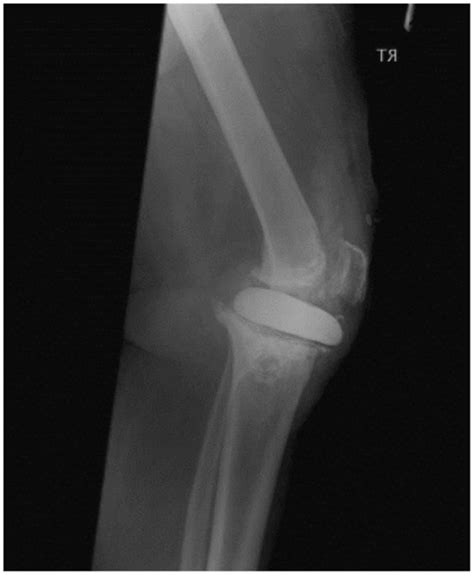 Frontiers | Patella Tendon Injuries Secondary to Cement Spacers Used at First-Stage Revision of ...