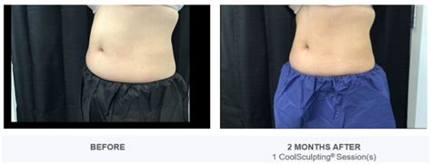 CoolSculpting - Reston Dermatology & Cosmetic Center