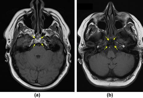 Benign and malignant diseases of the clivus - Clinical Radiology