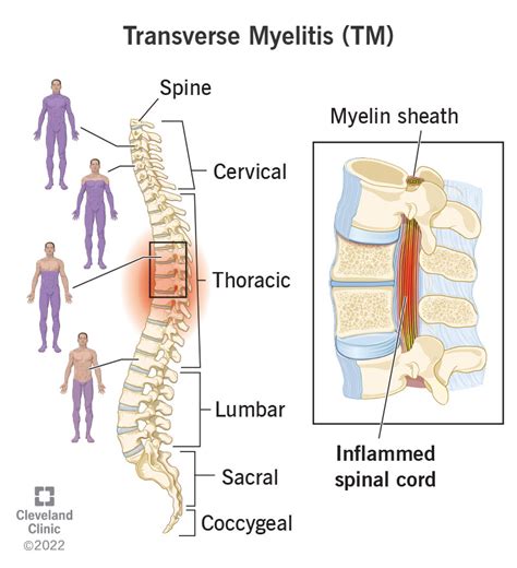 Transverse Myelitis (TM): Causes, Symptoms & Treatment