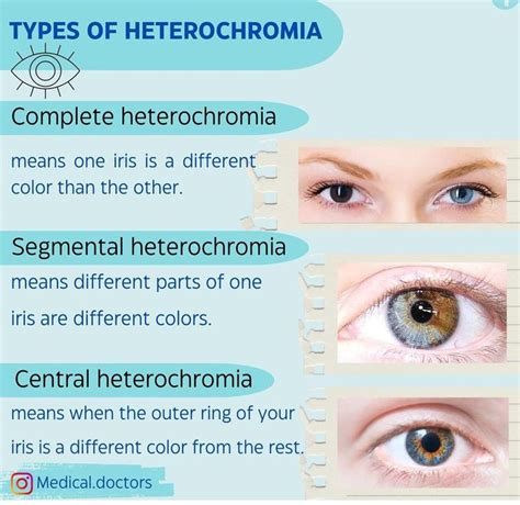 Heterochromia- Types - MEDizzy