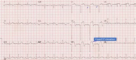 Anterior Wall Myocardial Infarction