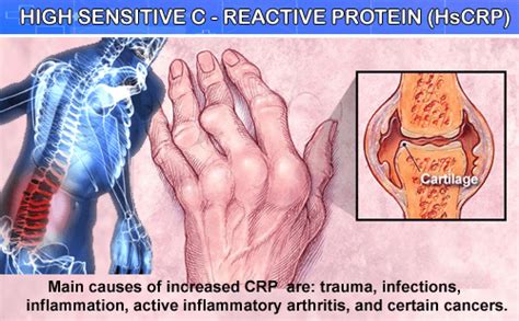 CRP (C-Reactive Protein)