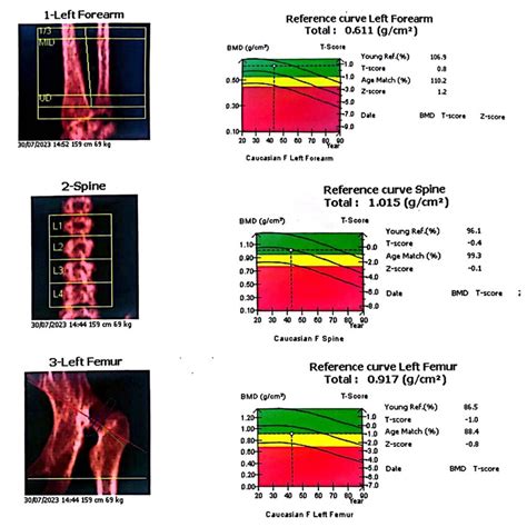 A DEXA scan was assessing the patient's bone density. The results... | Download Scientific Diagram