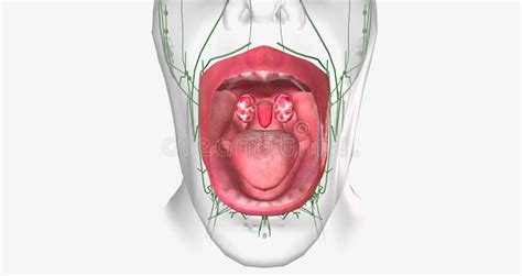 Strep Throat is a Common Condition Caused by a Bacterial Infection of ...