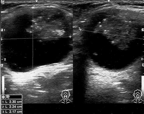 Ultrasound of thyroglossal duct cyst. Ultrasound of the neck detected a ...