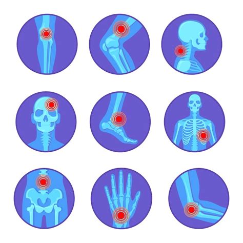 Enfermedades articulares ortopédicas dolor reumatoide hueso rodilla mano codo artritis ...