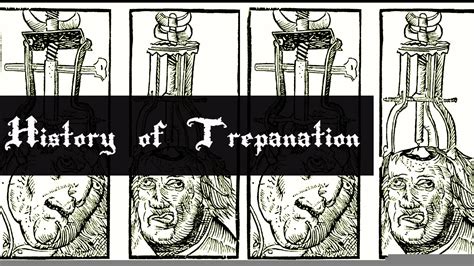 The History of Trepanation – Trepanning World