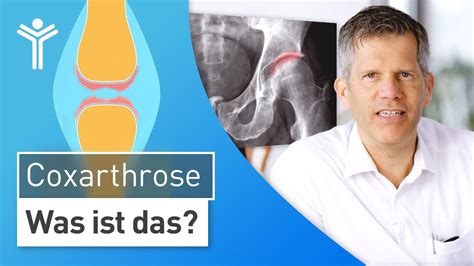 Coxarthrose einfach erklärt: Ursachen & Symptome | Hüftarthrose | Wissen, Erklären, Tipps