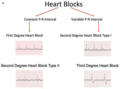 heart block ecg image 101 | Heart blocks, Emergency nursing, Cardiology nursing