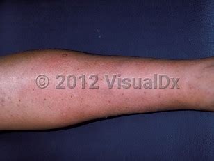 Calciphylaxis