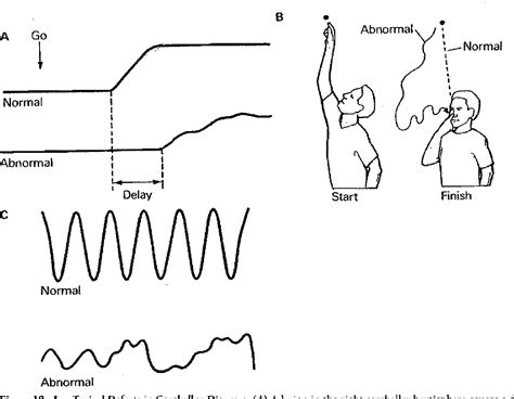 Figure 19-1 from Disorders of the Cerebellum and Its Connections | Semantic Scholar