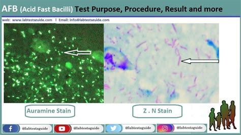 Sputum for AFB Test Purpose, Procedure, Result and more | Lab Tests Guide