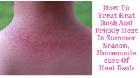 How To Treat Heat Rash And Prickly Heat In Summer Season, Homemade cure Of Heat Rash - Makeup Vine