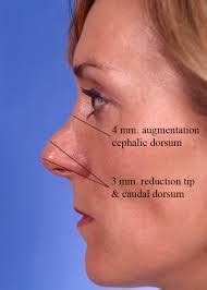 Rhinoplasty Chapter | Nasal Augmentation with Dorsal Implant