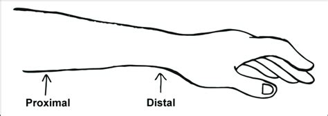 | Diagram showing the level of forearm amputation as well as the levels ...