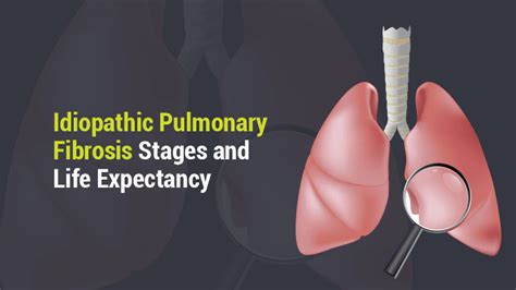 Idiopathic Pulmonary Fibrosis Stages And Life Expectancy