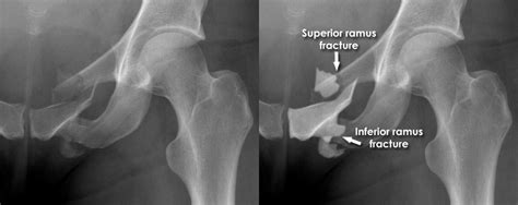 Superior Pubic Ramus Fracture