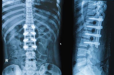 Spinal Fusion Before And After