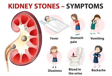 Free Vector | Kidney stones symptoms cartoon style infographic