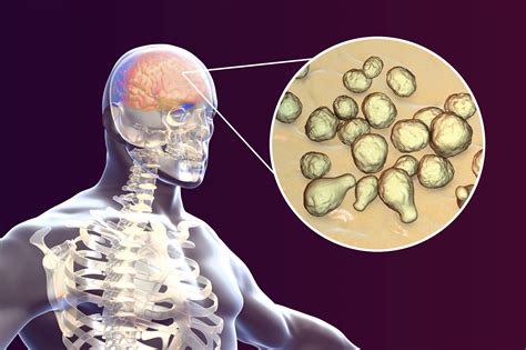 Cryptococcal Meningitis May Be Linked With Higher Mortality in PLWHIV - Infectious Disease Advisor